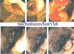 ดีท็อกล้างลำไส้